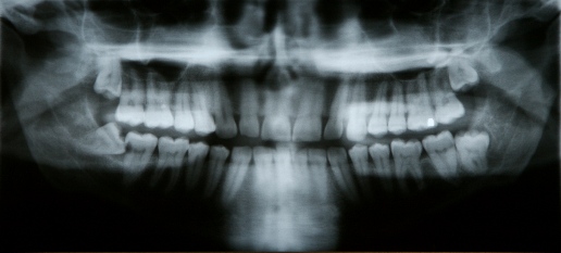 after-impacted-tooth